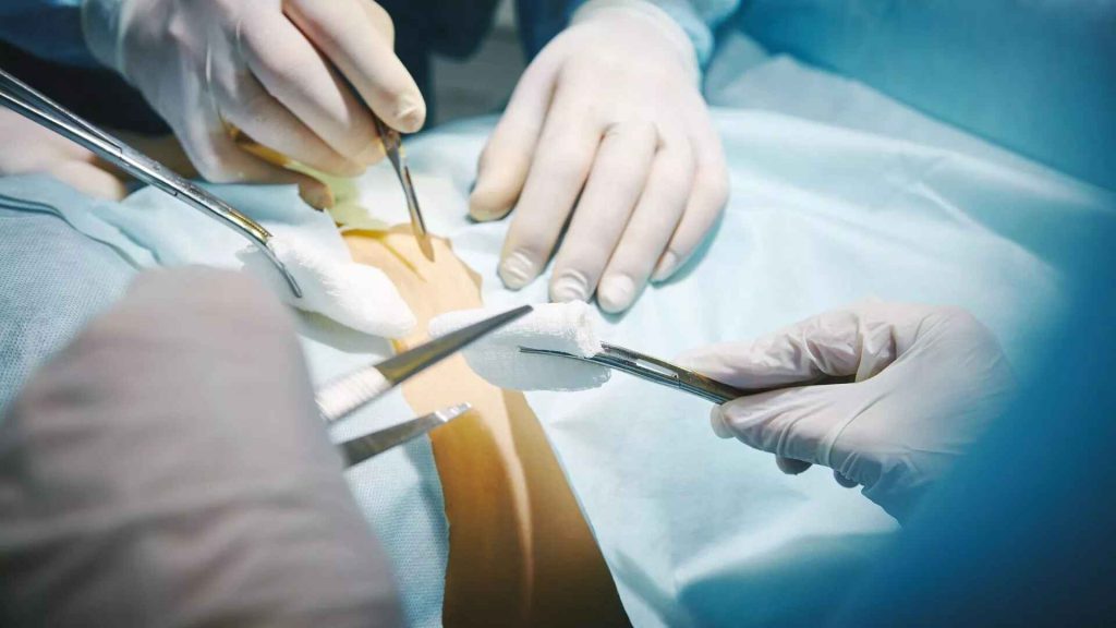 درمان سیاتیک با جراحی
