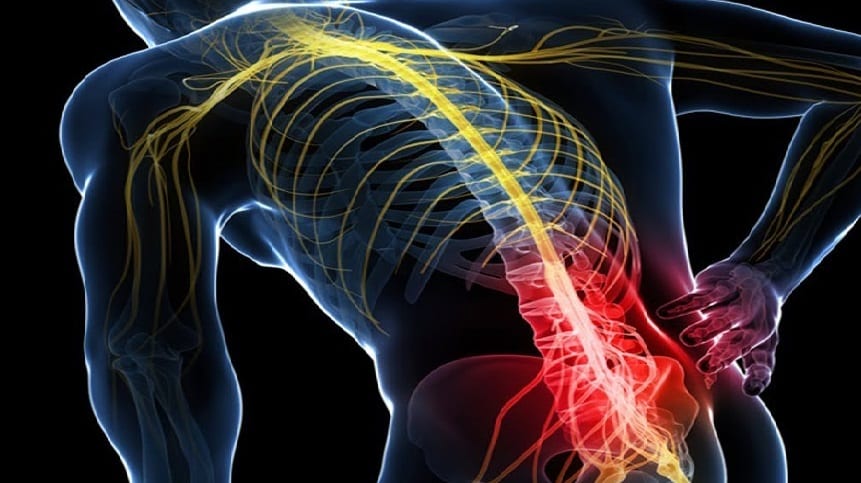 درمان سیاتیک برای همیشه