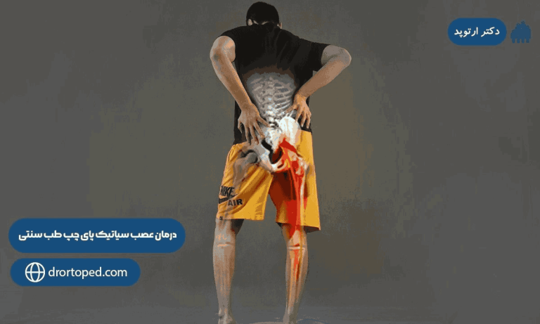 راهکارهای "درمان عصب سیاتیک پای چپ طب سنتی"+ عوارض عدم درمان